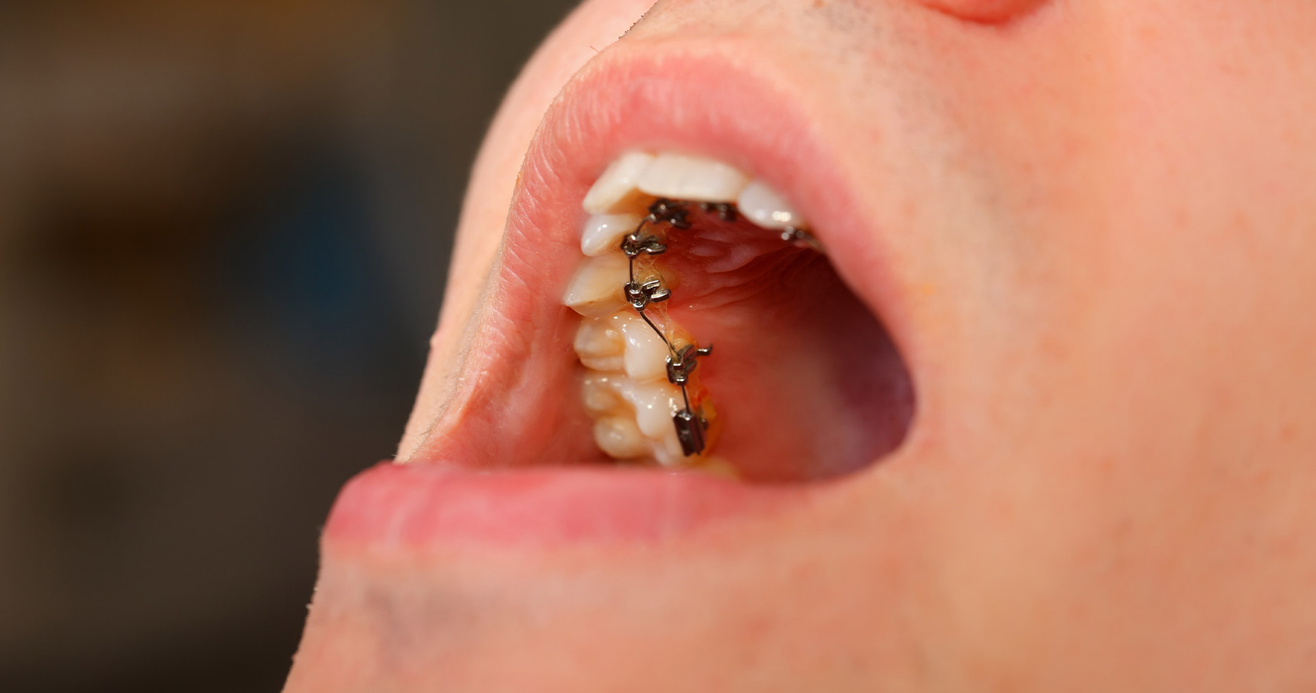 Lingual Braces in Tallahassee
